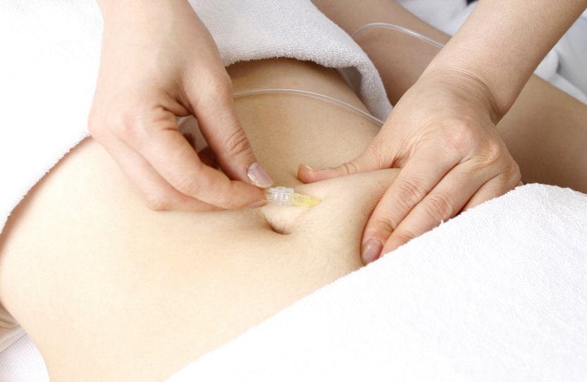 Karboksyterapia – naturalna stymulacja skóry