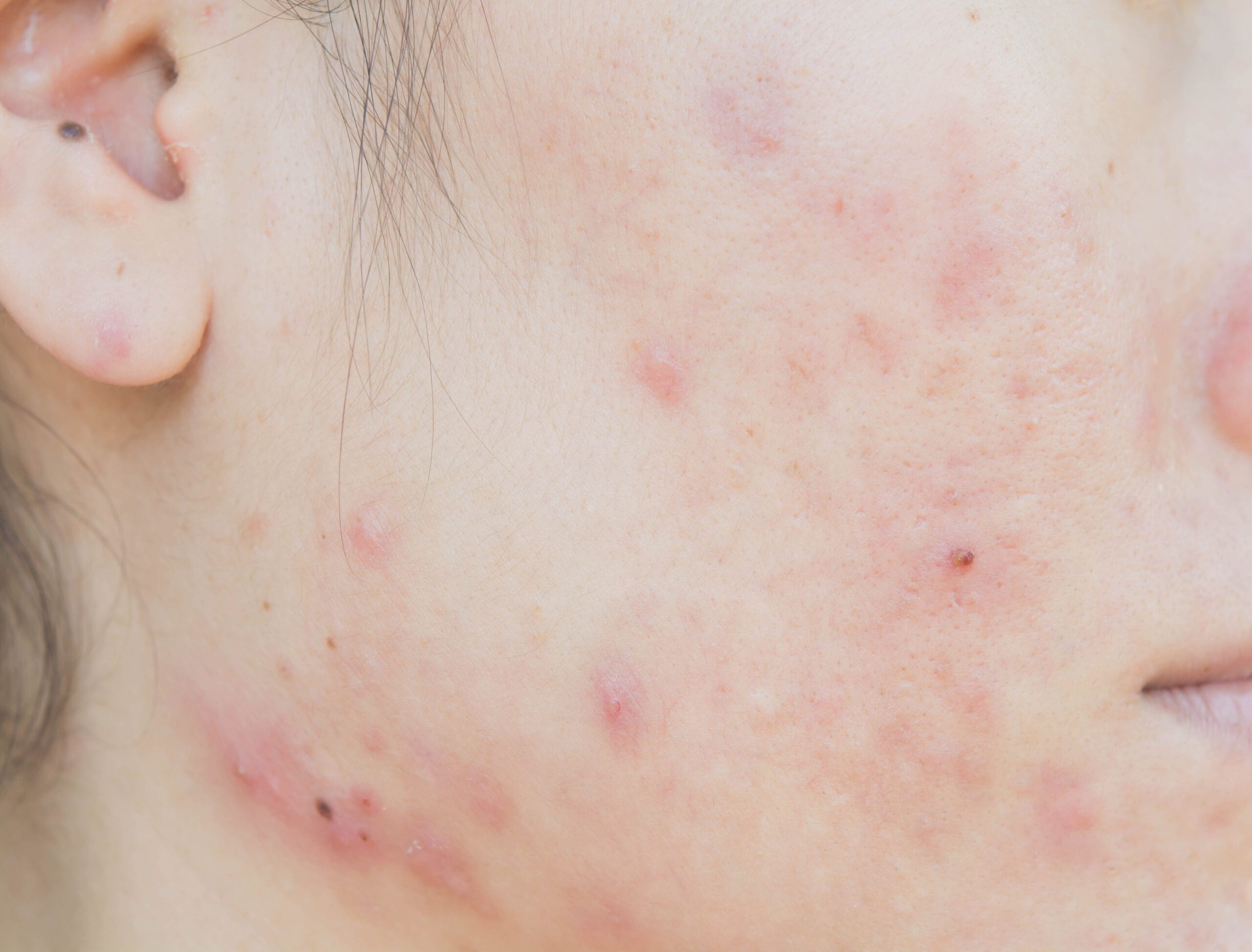 Postępowanie zabiegowe w acne tarda